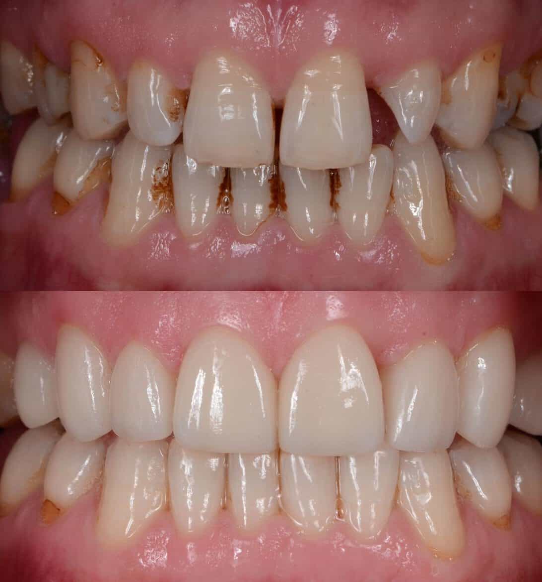 Vorher-Nachher-Vergleich bei Non-Prep-Veneers Behandlung in der Zahnarztpraxis St. Albantor Zahnarzt in Basel