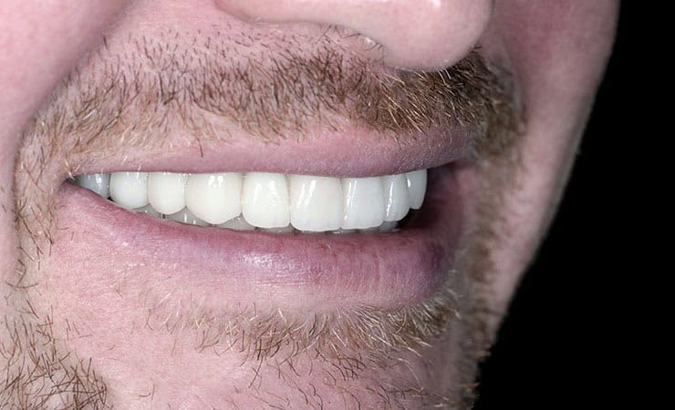 Nachher-Ergebnis nach kompletter Zahnsanierung mit Keramikkronen und Implantaten in Basel