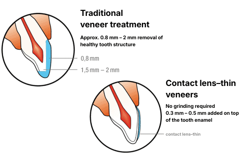 Veneers – ästhetische Zahnmedizin Basel