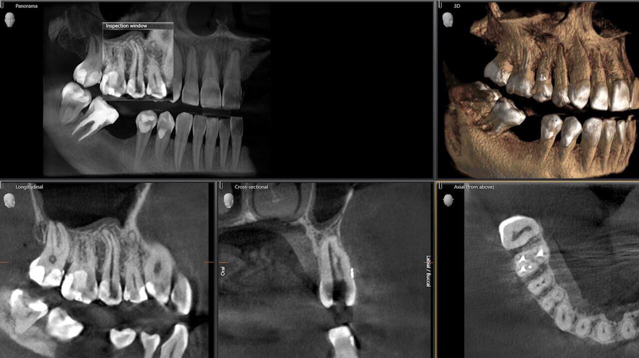 3D-Röntgen und CBCT-Diagnostik zur Implantatplanung in Basel