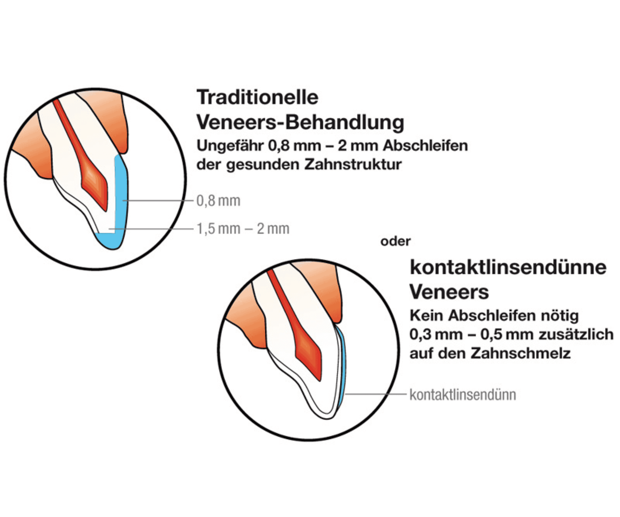Grafik zum Vergleich No-Prep-Veneers und traditionelle Veneers bei St. Albantor Zahnarzt in Basel
