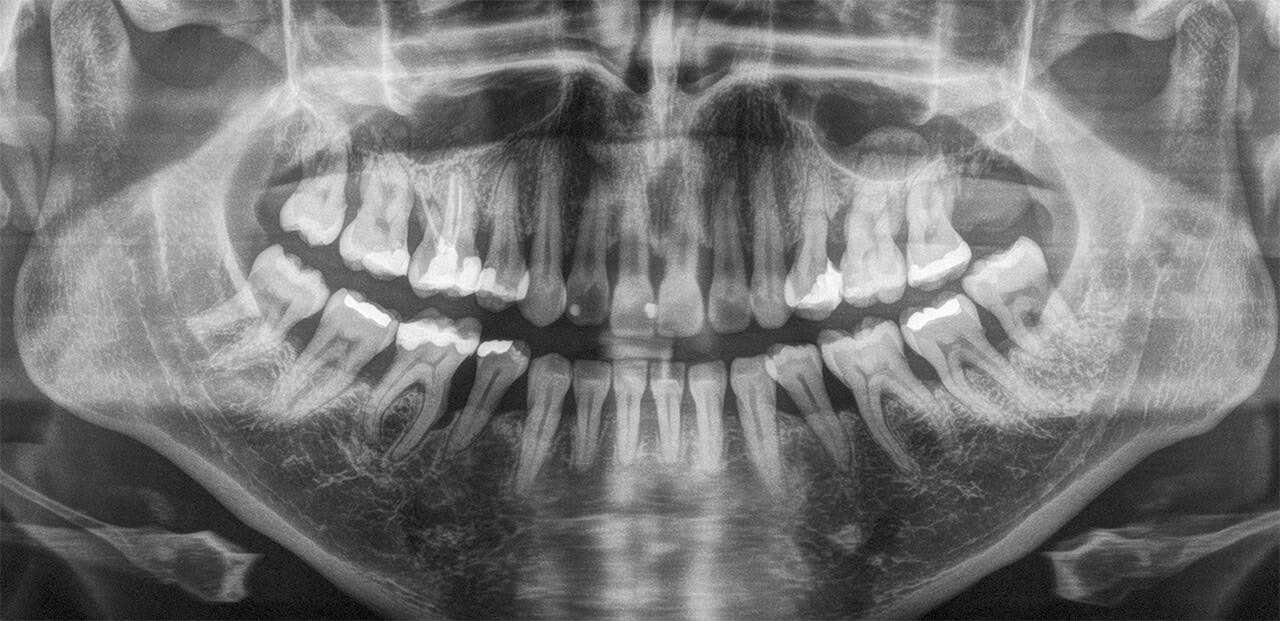 Röntgenbild zur Diagnostik von Parodontitis in der Zahnarztpraxis in Basel